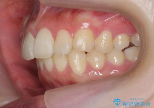 [ ワイヤー小矯正+マウスピース矯正 ]  前歯のねじれを短期間で治したいの治療中