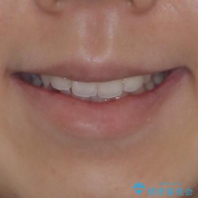 後戻りの再矯正 ワイヤー装置でデコボコと隙間を改善の治療前(顔貌)