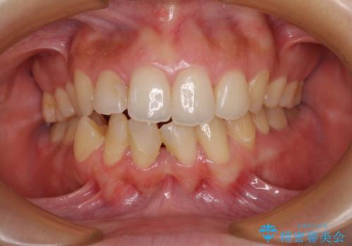 後戻りの再矯正 ワイヤー装置でデコボコと隙間を改善の症例 治療前