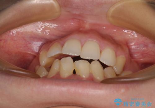 後戻りの再矯正 ワイヤー装置でデコボコと隙間を改善の治療前