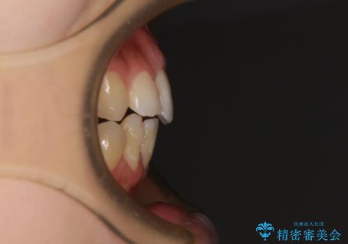 後戻りの再矯正 ワイヤー装置でデコボコと隙間を改善の治療前