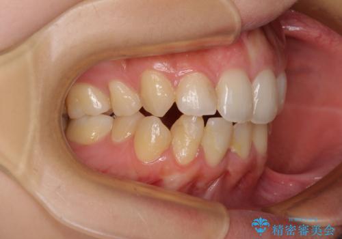 後戻りの再矯正 ワイヤー装置でデコボコと隙間を改善の治療前
