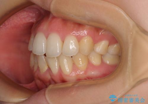 後戻りの再矯正 ワイヤー装置でデコボコと隙間を改善の治療前