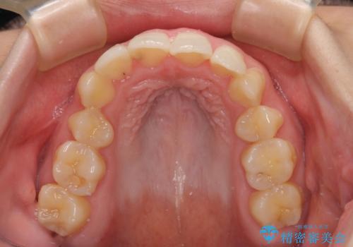 後戻りの再矯正 ワイヤー装置でデコボコと隙間を改善の治療前