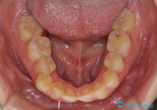 後戻りの再矯正 ワイヤー装置でデコボコと隙間を改善の治療前