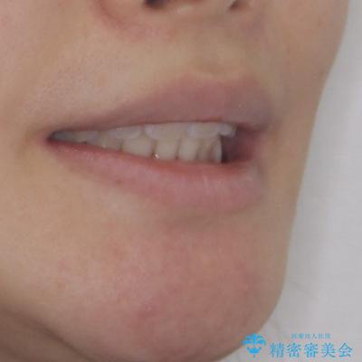 飛び出した上顎前歯 ワイヤー装置にて抜歯矯正治療の治療後(顔貌)