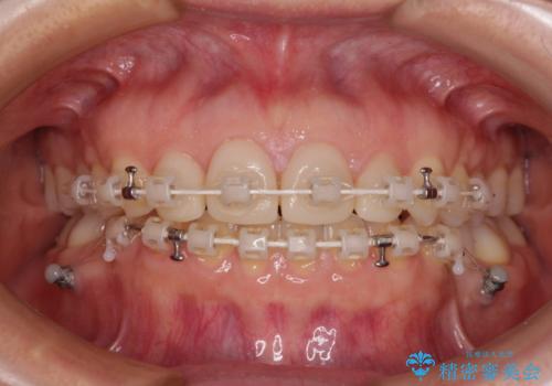 前歯を綺麗にしたい　部分矯正とセラミック治療の治療中