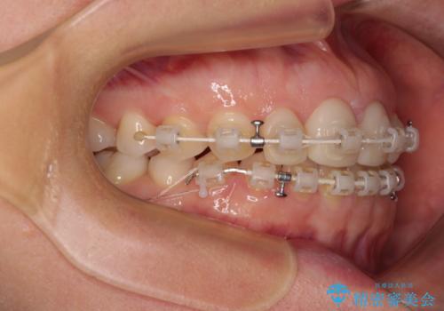 前歯を綺麗にしたい 部分矯正とセラミック治療の治療中