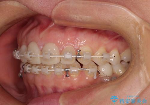 前歯を綺麗にしたい 部分矯正とセラミック治療の治療中