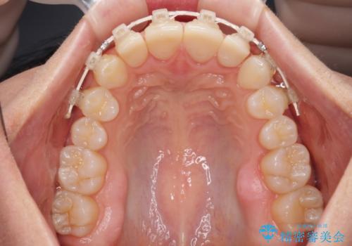 前歯を綺麗にしたい 部分矯正とセラミック治療の治療中