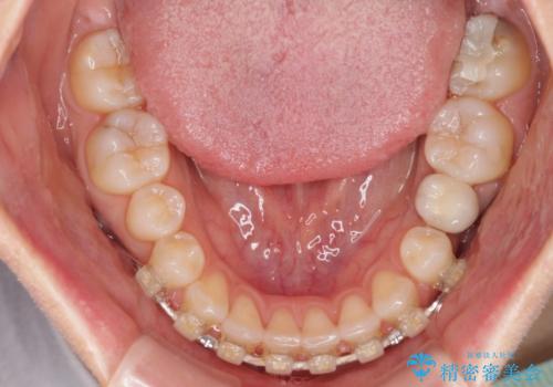 前歯を綺麗にしたい 部分矯正とセラミック治療の治療中