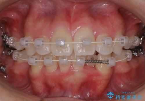 【抜歯】ワイヤー装置で綺麗な歯並び!口元も劇的変化の治療中