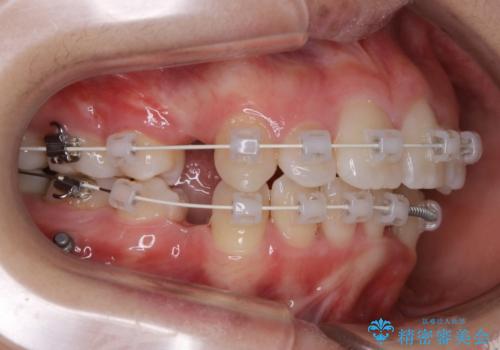 【抜歯】ワイヤー装置で綺麗な歯並び!口元も劇的変化の治療中