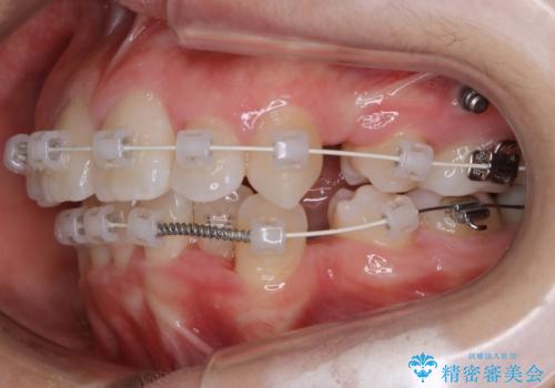 【抜歯】ワイヤー装置で綺麗な歯並び!口元も劇的変化の治療中