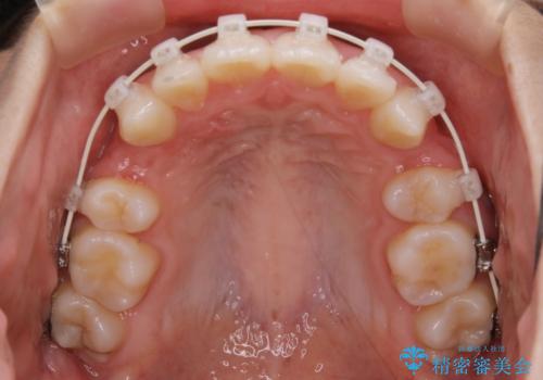 【抜歯】ワイヤー装置で綺麗な歯並び!口元も劇的変化の治療中