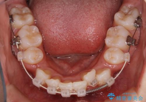【抜歯】ワイヤー装置で綺麗な歯並び!口元も劇的変化の治療中