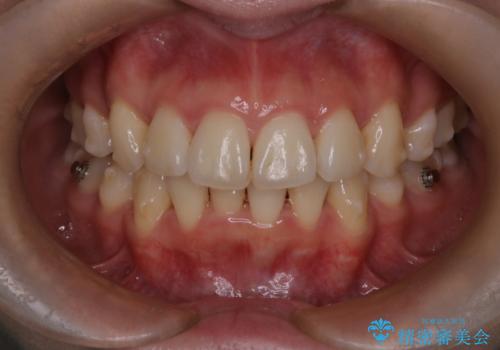 【インビザライン】抜歯矯正で口元も改善の治療中