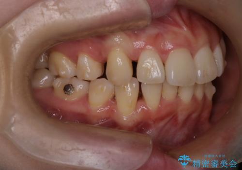 【インビザライン】抜歯矯正で口元も改善の治療中