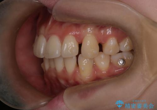 【インビザライン】抜歯矯正で口元も改善の治療中