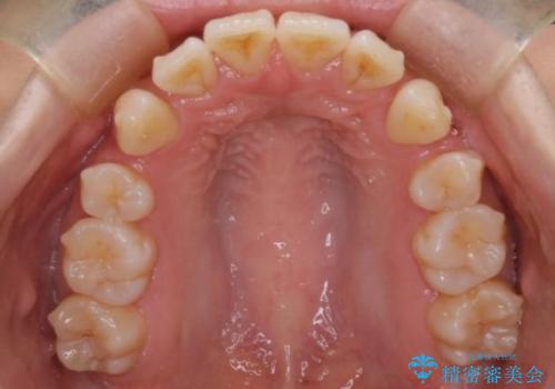 【インビザライン】抜歯矯正で口元も改善の治療中