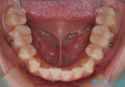 【インビザライン】抜歯矯正で口元も改善の治療中