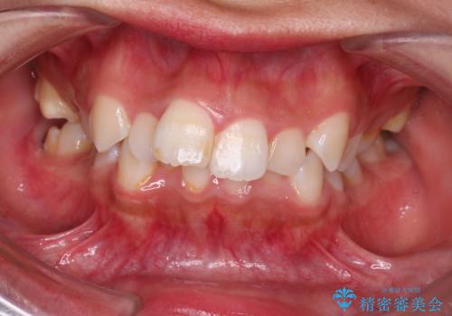 【審美ワイヤー】重度の叢生を治療