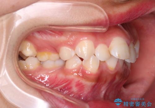 【審美ワイヤー】重度の叢生を治療の治療前