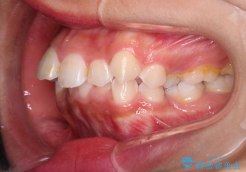 【審美ワイヤー】重度の叢生を治療の治療前