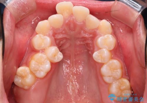 【審美ワイヤー】重度の叢生を治療の治療前