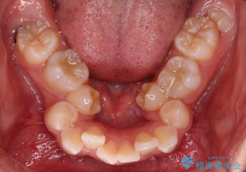 【審美ワイヤー】重度の叢生を治療の治療前