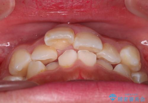 【審美ワイヤー】重度の叢生を治療の治療前