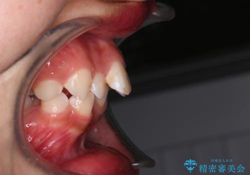 【審美ワイヤー】重度の叢生を治療の治療前