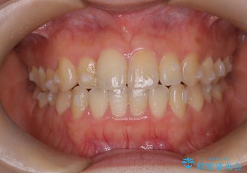 【インビザライン】前歯のがたつきを目立たない装置で治療の治療中