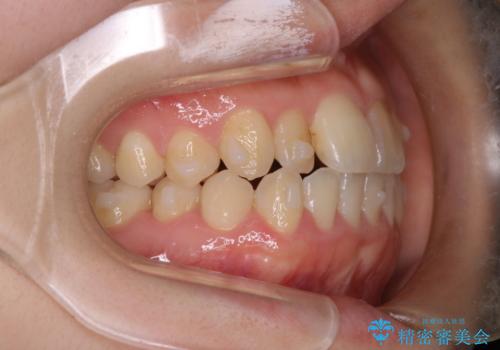【インビザライン】前歯のがたつきを目立たない装置で治療の治療中