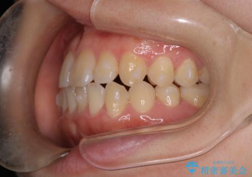 【インビザライン】前歯のがたつきを目立たない装置で治療の治療中