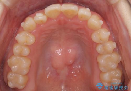 【インビザライン】前歯のがたつきを目立たない装置で治療の治療中