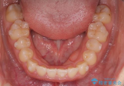 【インビザライン】前歯のがたつきを目立たない装置で治療の治療中