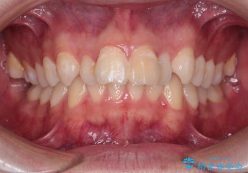 【インビザライン】抜歯矯正で前歯を下げたい。の治療前