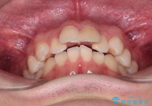 【インビザライン】抜歯矯正で前歯を下げたい。の治療前