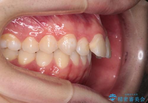 【インビザライン】抜歯矯正で前歯を下げたい。の治療前