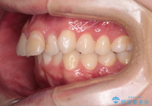 【インビザライン】抜歯矯正で前歯を下げたい。の治療前