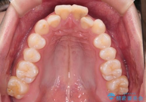 【インビザライン】抜歯矯正で前歯を下げたい。の治療前