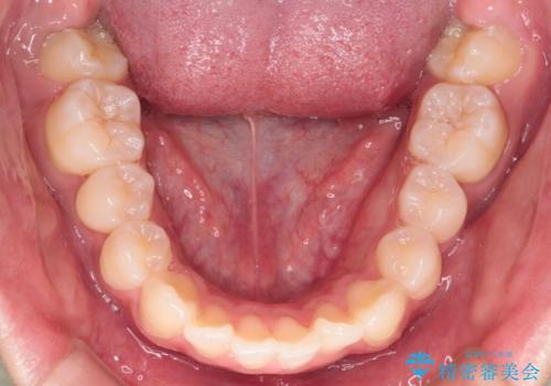 【インビザライン】抜歯矯正で前歯を下げたい。の治療前