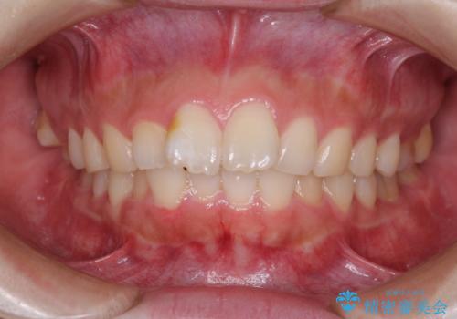 前歯のデコボコをインビザラインできれいに整えるの症例 治療前