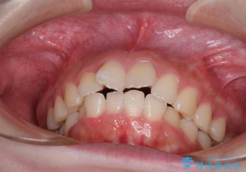 前歯のデコボコをインビザラインできれいに整えるの治療前