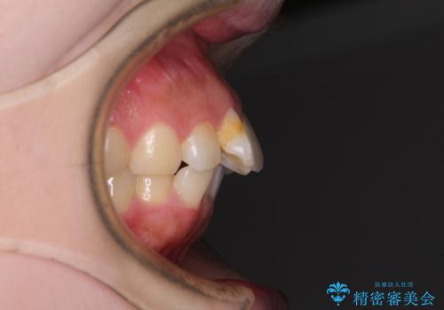 前歯のデコボコをインビザラインできれいに整えるの治療前