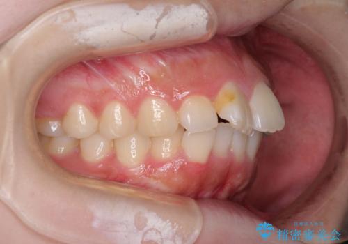 前歯のデコボコをインビザラインできれいに整えるの治療前