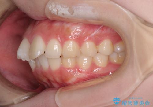 前歯のデコボコをインビザラインできれいに整えるの治療前