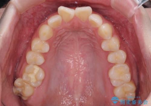 前歯のデコボコをインビザラインできれいに整えるの治療前
