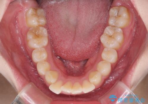 前歯のデコボコをインビザラインできれいに整えるの治療前